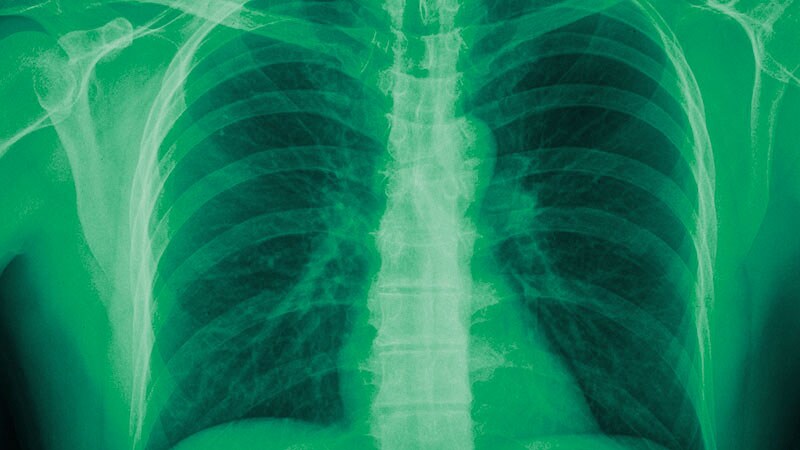 COPD Exacerbations: BET With Prednisolone Noninferior to ST