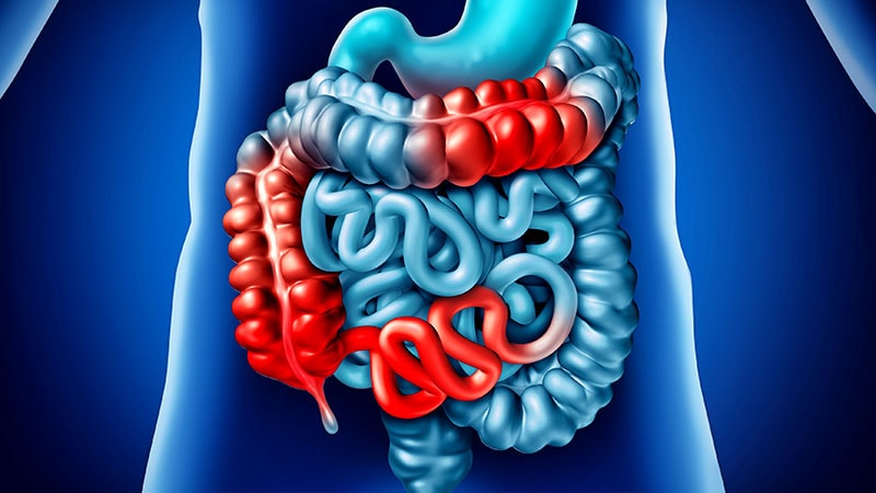 Guideline Affirms Role of Biomarkers in Crohn's Disease