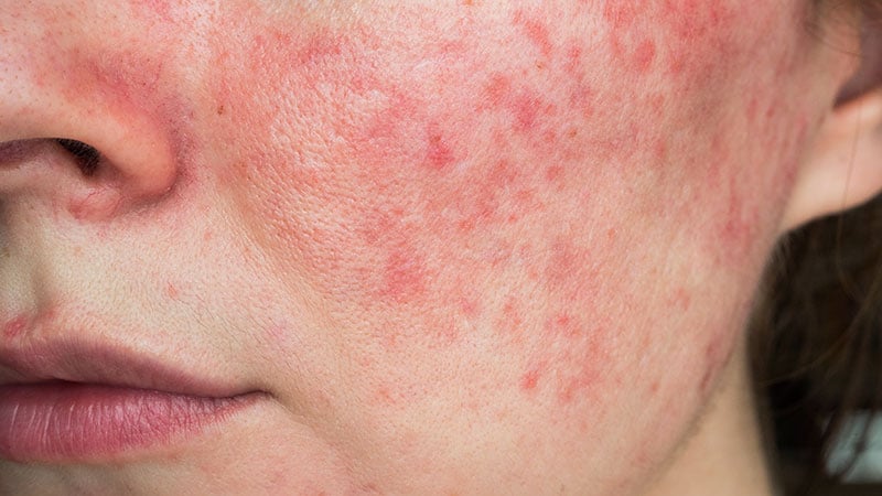 Impact of Pregnancy on Rosacea Unpredictable, Study Suggests