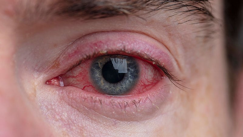 Conjunctivitis: How Common Is It in Patients on Dupilumab?