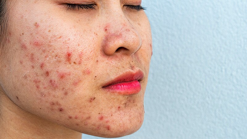 Acne in Primary Care: The Best of Times?