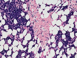 High Response Rates With Talquetamab in Advanced Myeloma