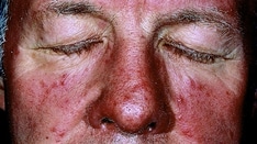 Topical Ivermectin Study Sheds Light on Dysbiosis in Rosacea